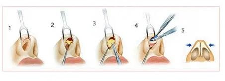 微調鼻子需要多少錢，全面解析費用因素與注意事項，微調鼻子費用全解析，費用因素與注意事項，需要多少錢？