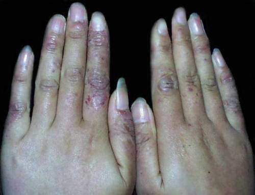 根治凍瘡，預(yù)防復(fù)發(fā)，全面解析凍瘡的治療方法，根治凍瘡，預(yù)防復(fù)發(fā)，全面解析凍瘡治療策略