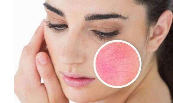 如何有效去除紅血絲，最佳方法與實(shí)用建議，紅血絲去除攻略，最佳方法與實(shí)用建議