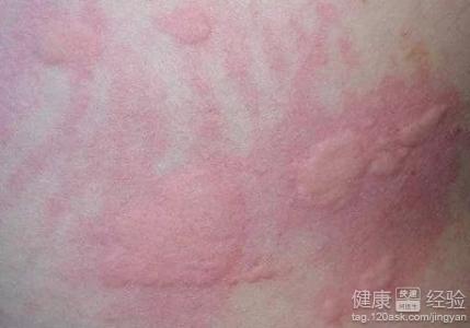 風疹是怎么引起的，風疹的成因解析