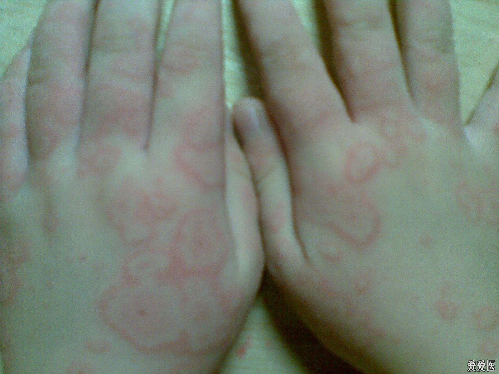 關(guān)于螨蟲過敏圖片與澳彩資料的查詢，來自94848.cσm的詳盡資源，螨蟲過敏圖片與澳彩資料查詢，詳盡資源來自94848.cσm