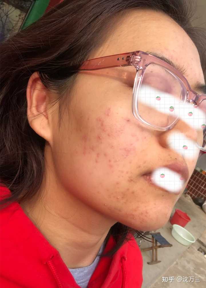 消除痤瘡留下的紅色痘印的有效方法，消除紅色痘印，痤瘡后的護(hù)膚秘訣