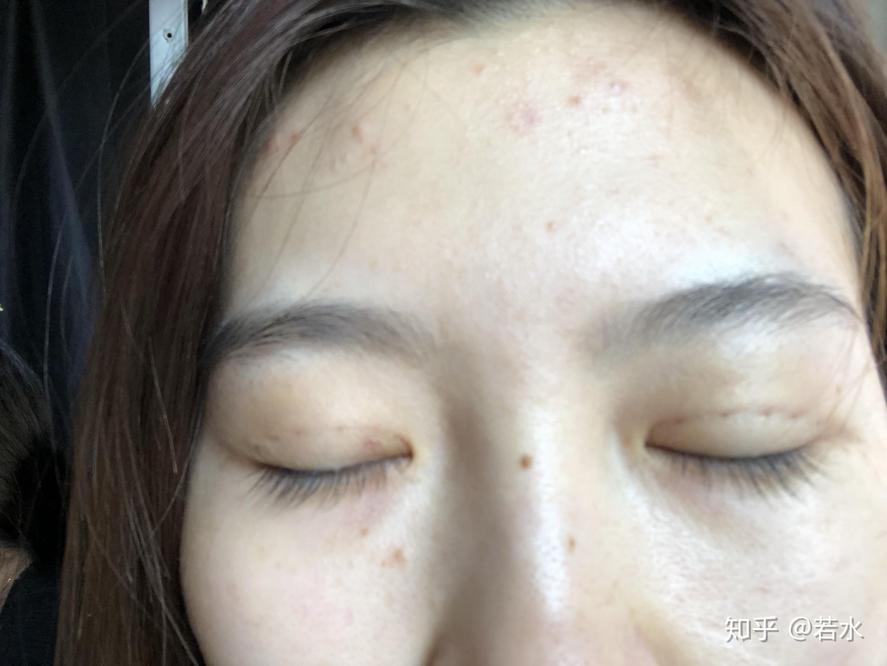 雙眼皮埋線手術(shù)效果持久性解析，持續(xù)時間與影響因素探討，雙眼皮埋線手術(shù)的持久性與影響因素深度解析