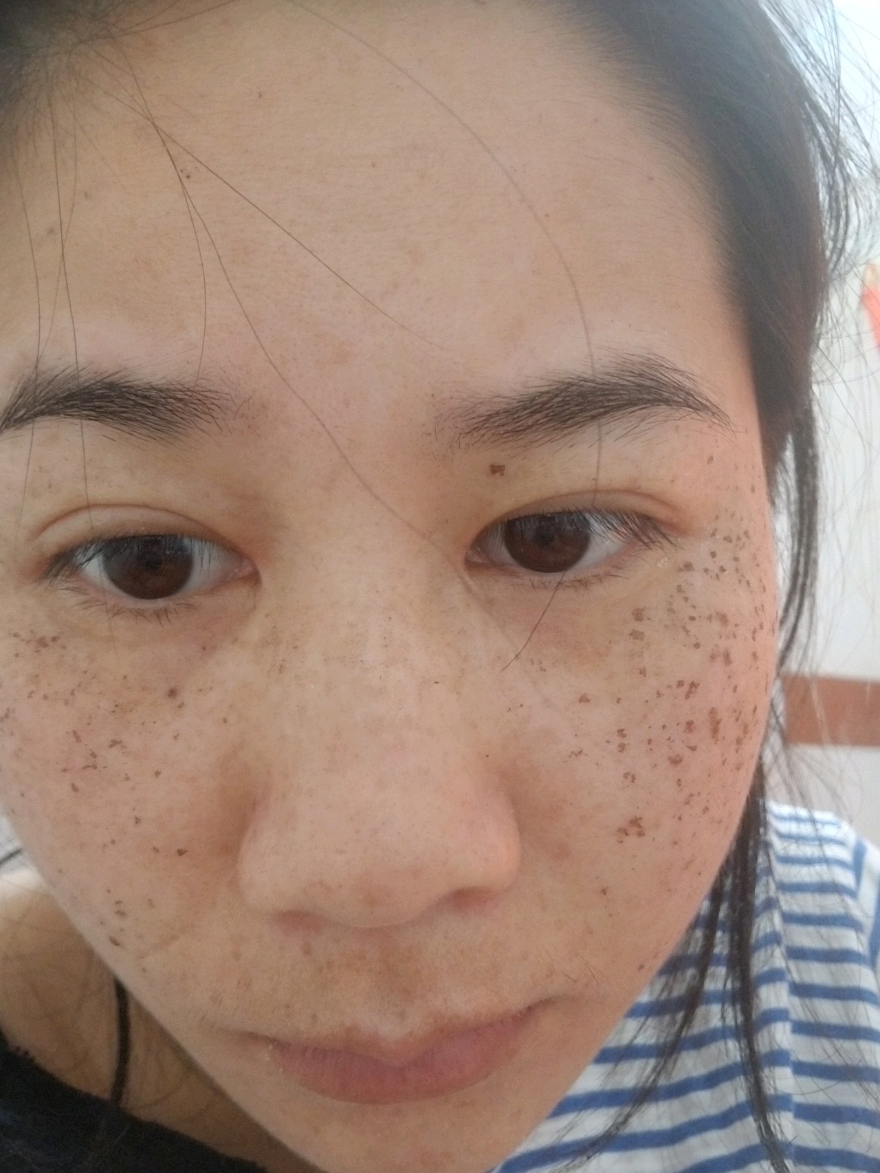 激光祛斑后的15天，見(jiàn)證肌膚煥變的瞬間，激光祛斑后15天，肌膚煥新瞬間見(jiàn)證