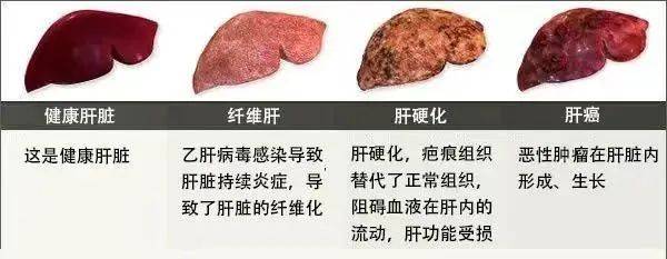 我的肝硬化三十年，經(jīng)歷、挑戰(zhàn)與希望，肝硬化三十年，我的經(jīng)歷、挑戰(zhàn)與希望的歷程