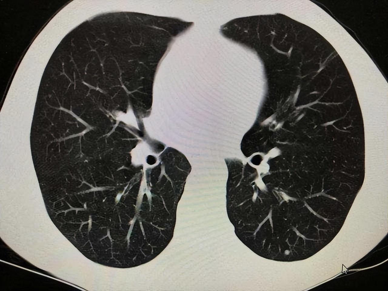 關(guān)于打科興后出現(xiàn)肺結(jié)節(jié)的探討，科興疫苗接種與肺結(jié)節(jié)關(guān)系探討