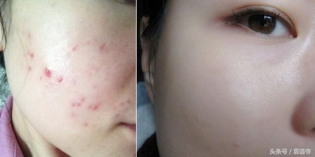 如何祛痘最快最有效的方法，全面解析痘痘成因與解決方案，揭秘最快最有效的祛痘方法，全面解析痘痘成因與解決方案！