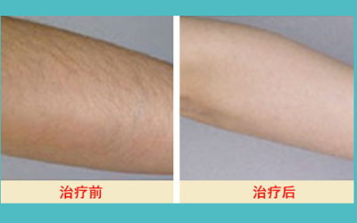 激光脫毛的價(jià)格解析，多少錢才能擁有絲滑肌膚？，激光脫毛價(jià)格詳解，多少錢能擁有絲滑肌膚？