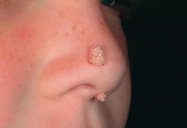 如何判斷是否為雞眼——全面解析雞眼癥狀與診斷方法，雞眼癥狀詳解，診斷方法與判斷指南