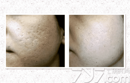 5次點陣激光去痘坑效果深度解析，五次點陣激光去痘坑深度解析，效果與影響探討